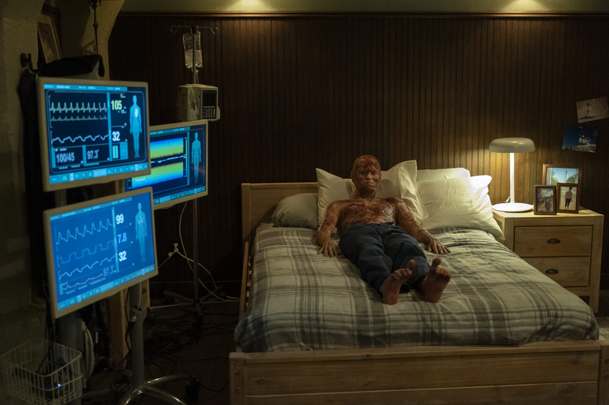 Jacob Busler als verbrannter Vampir in einem Bett liegend. Links einige Monitore mit medizinischen Anzeigen.