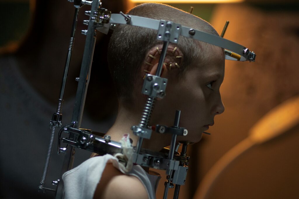 Die junge Alexia kurz nach der OP nach dem Unfall mit einem stützenden Gestell um den Kopf in Titane.